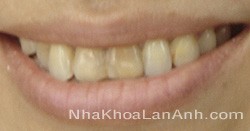 Răng sậm màu – Nguyên nhân và cách khắc phục