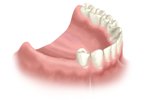 Phục hình cho trường hợp mất nhiều răng như thế nào?