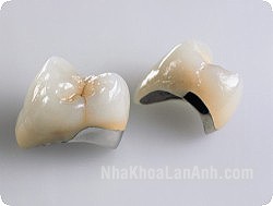 Mão răng – Cầu răng sứ kim loại