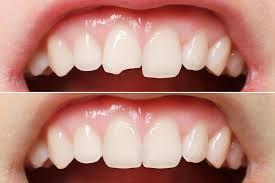 Răng sứ bị mẻ – Nguyên nhân, cách phòng ngừa và khắc phục.