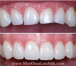 Đặc điểm phục hình răng sứ MCX5 và MCXL