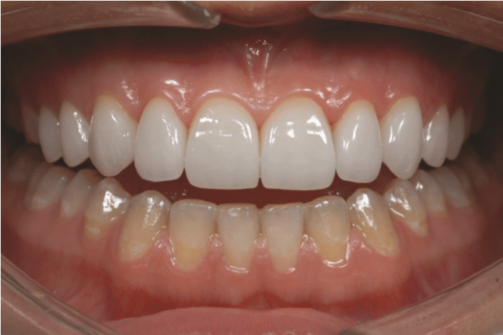 Những câu hỏi thường gặp về răng sứ Cerec/Inlab tại Nha Khoa Lan Anh