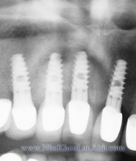 Implant trong trường hợp mất nhiều răng