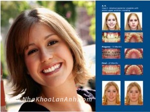 Chỉnh nha là gì? Niềng răng bao gồm những thành phần nào?