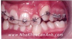 Diễn biến các giai đoạn của trường hợp chỉnh nha – niềng răng chen chúc