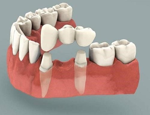 Bọc răng sứ thẩm mỹ và những điều cần biết