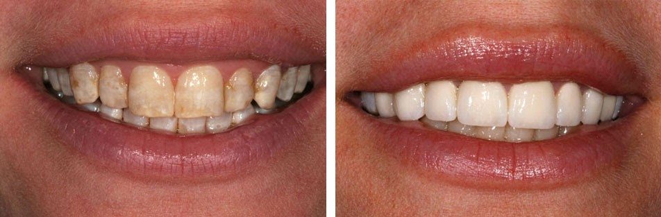 Tôi muốn hỏi giá làm răng sứ Zirconia và giá làm răng sứ Cerec. Với 2 loại răng sứ này thì răng sứ nào tốt hơn?