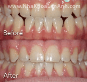 Chỉnh nha phải nhổ nhiều răng, vậy có ảnh hưởng sức khỏe của răng không?