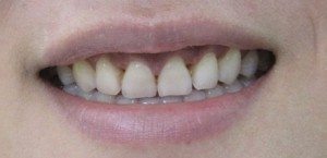 Tôi muốn làm răng sứ thẩm mỹ thì có thể khắc phục cười hở lợi luôn không?