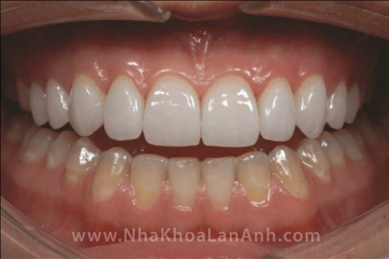 Màu sắc, thẩm mỹ của răng sứ Cerec như thế nào?