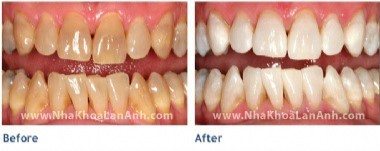 Răng sậm màu do kháng sinh, tẩy trắng răng bằng đèn Zoom có trắng được không?