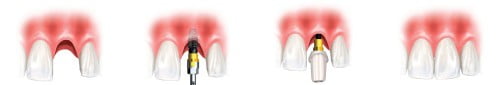 Trồng implant mất bao lâu?