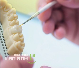 Răng sứ loại nào tốt