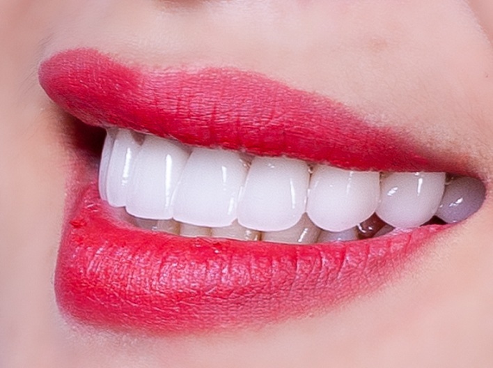 Để có chiếc răng sứ vừa trong, vừa sống động lại bền chắc theo thời gian