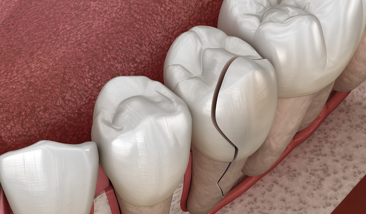 Bạn đã biết về tình trạng nứt, tét răng chưa?
