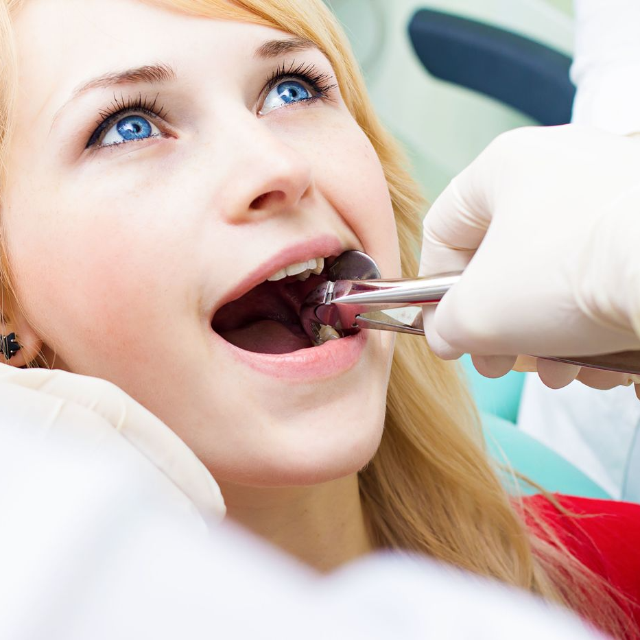 Điều gì là quan trọng nhất khi nhổ răng?