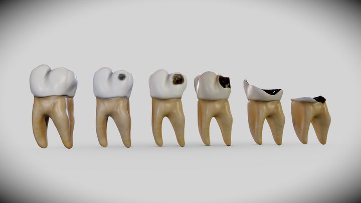 Sâu răng ở mức độ nào thì bạn nên gặp bác sĩ?
