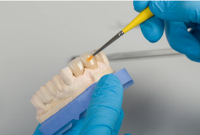Nếu răng bạn bị mẻ, bể vỡ thì nên trám thẩm mỹ, dán Veneer sứ hay bọc sứ toàn bộ răng