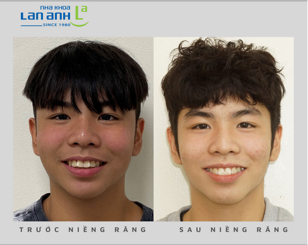 Bạn quan tâm đến điều gì khi niềng răng cho trẻ em?