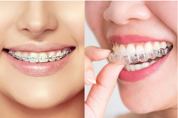 Nên niềng răng bằng mắc cài hay khay Invisalign?