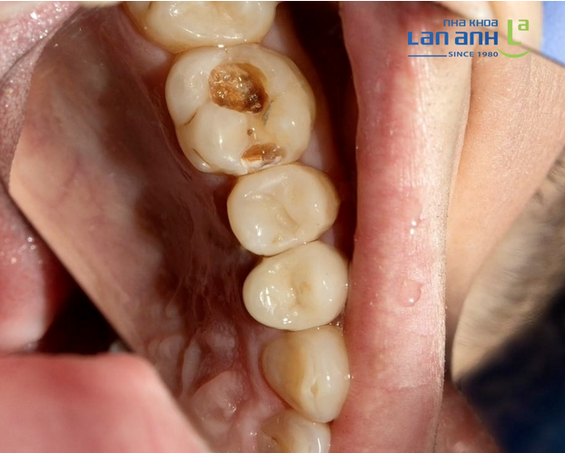 Sâu răng diễn ra như thế nào?