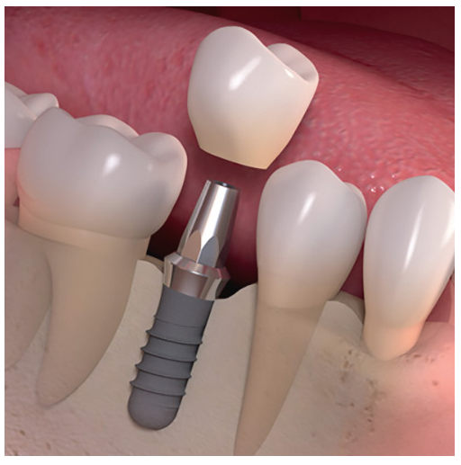 Thương hiệu của Implant có ảnh hưởng đến kết quả điều trị không?