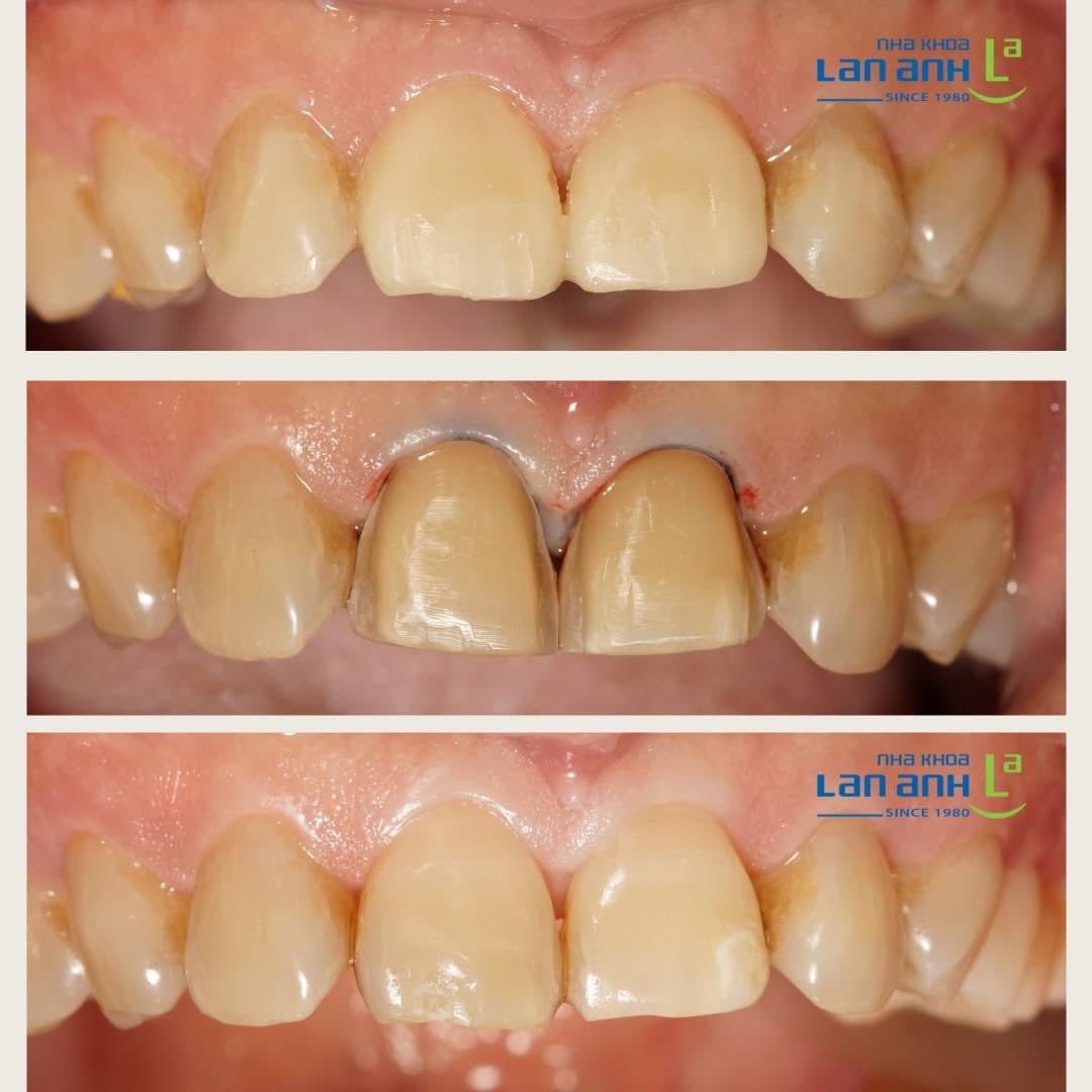 Một số trường hợp phục hình thẩm mỹ tại Nha Khoa Lan Anh