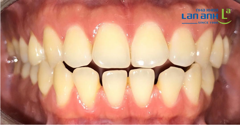 Một số trường hợp chỉnh nha bằng Invisalign