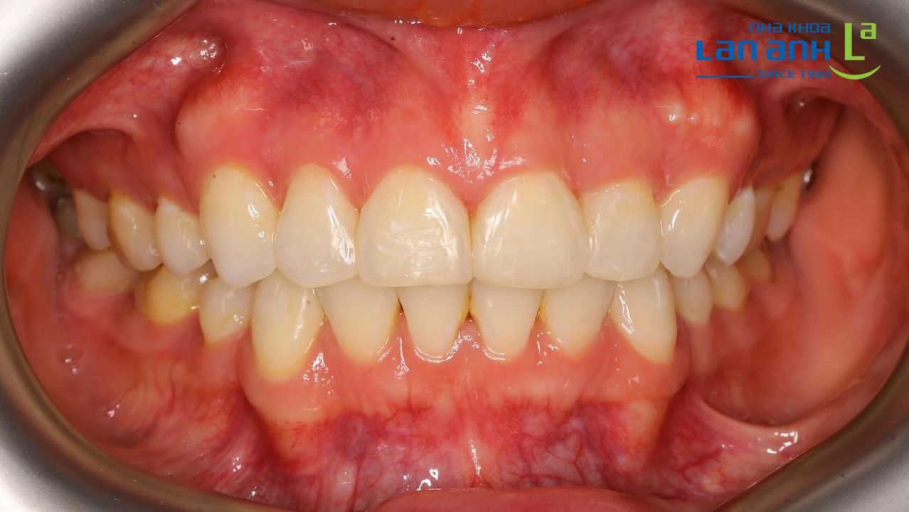 Niềng răng bằng mắc cài tự khóa Smart Clip 3M