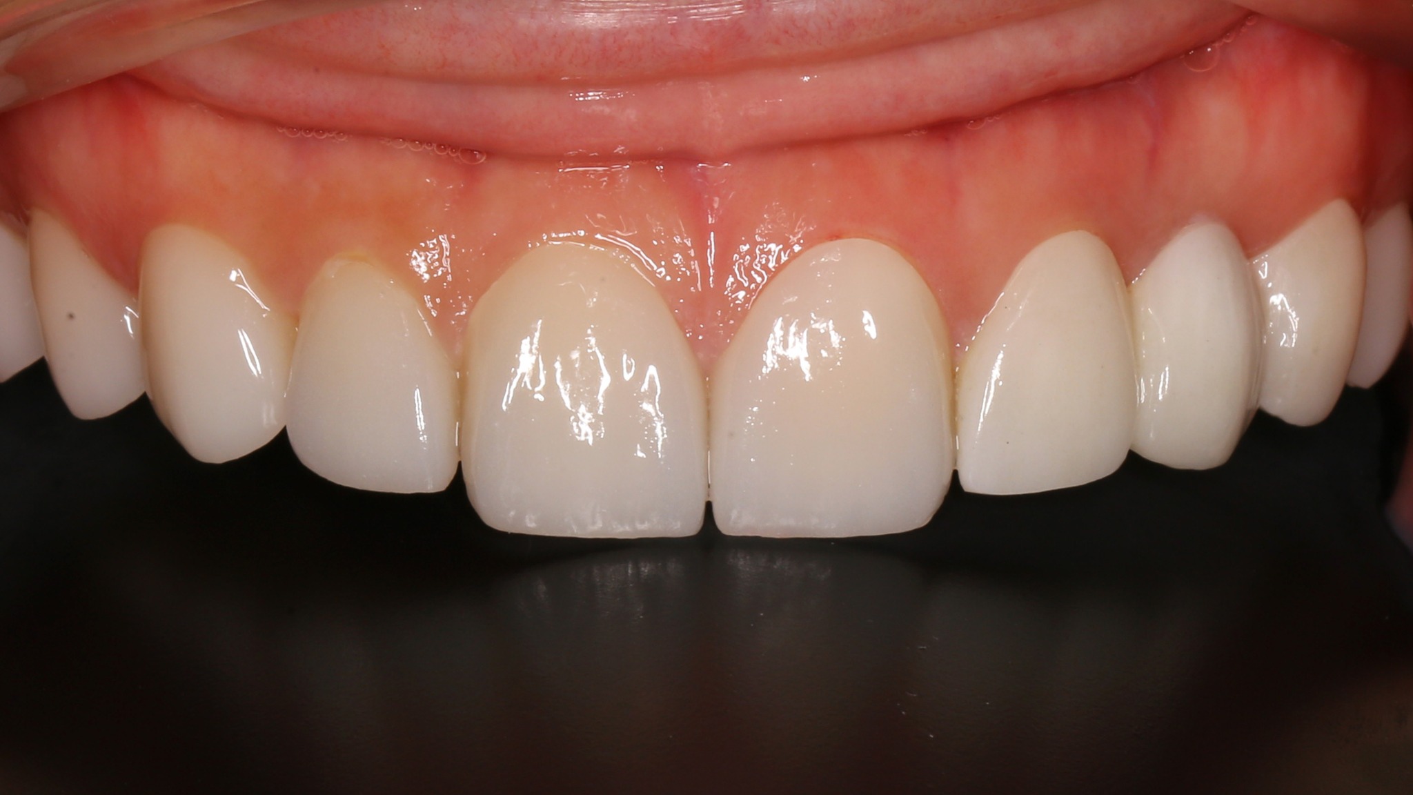 Nét đẹp tự nhiên của Veneer