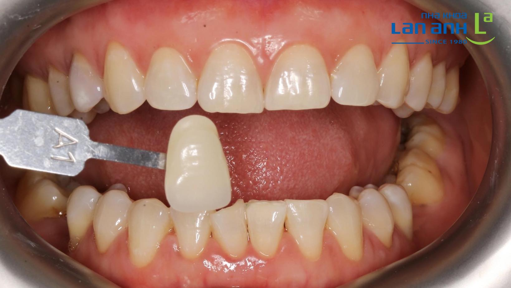 Răng trắng đẹp tự nhiên nhờ tẩy trắng