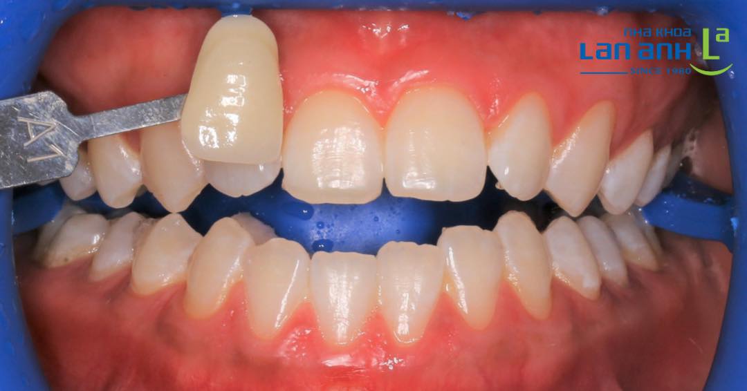 Nhẹ nhàng tẩy trắng răng chỉ sau 90 phút