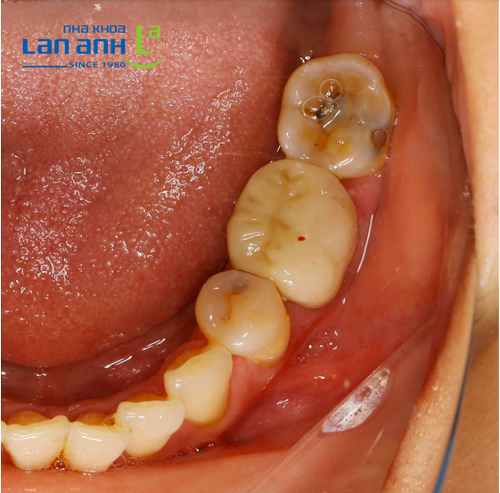 Thêm 1 răng sâu lớn bể vỡ được bọc lại để “gia cố” tại nha khoa Lan Anh