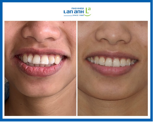 Niềng răng Invisalign cho trường hợp khó