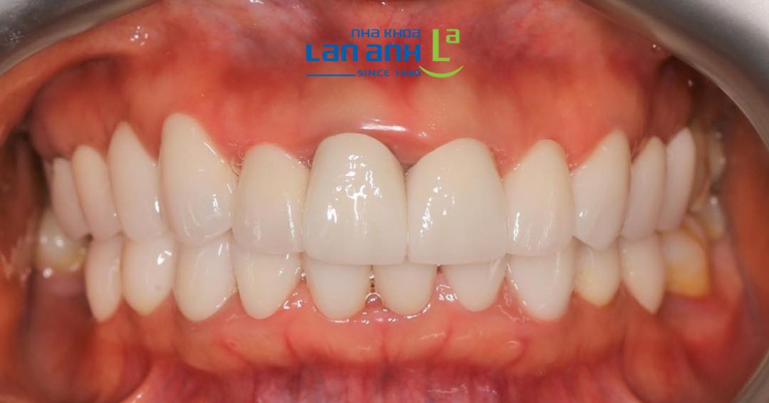 Làm răng sứ cần chú ý những gì?