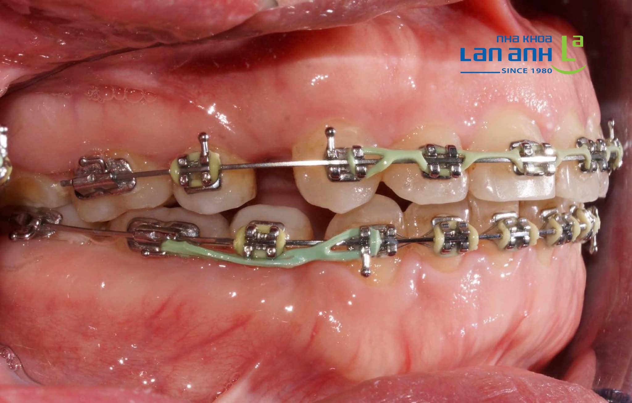 Chuyển nơi điều trị chỉnh nha có khả thi không?