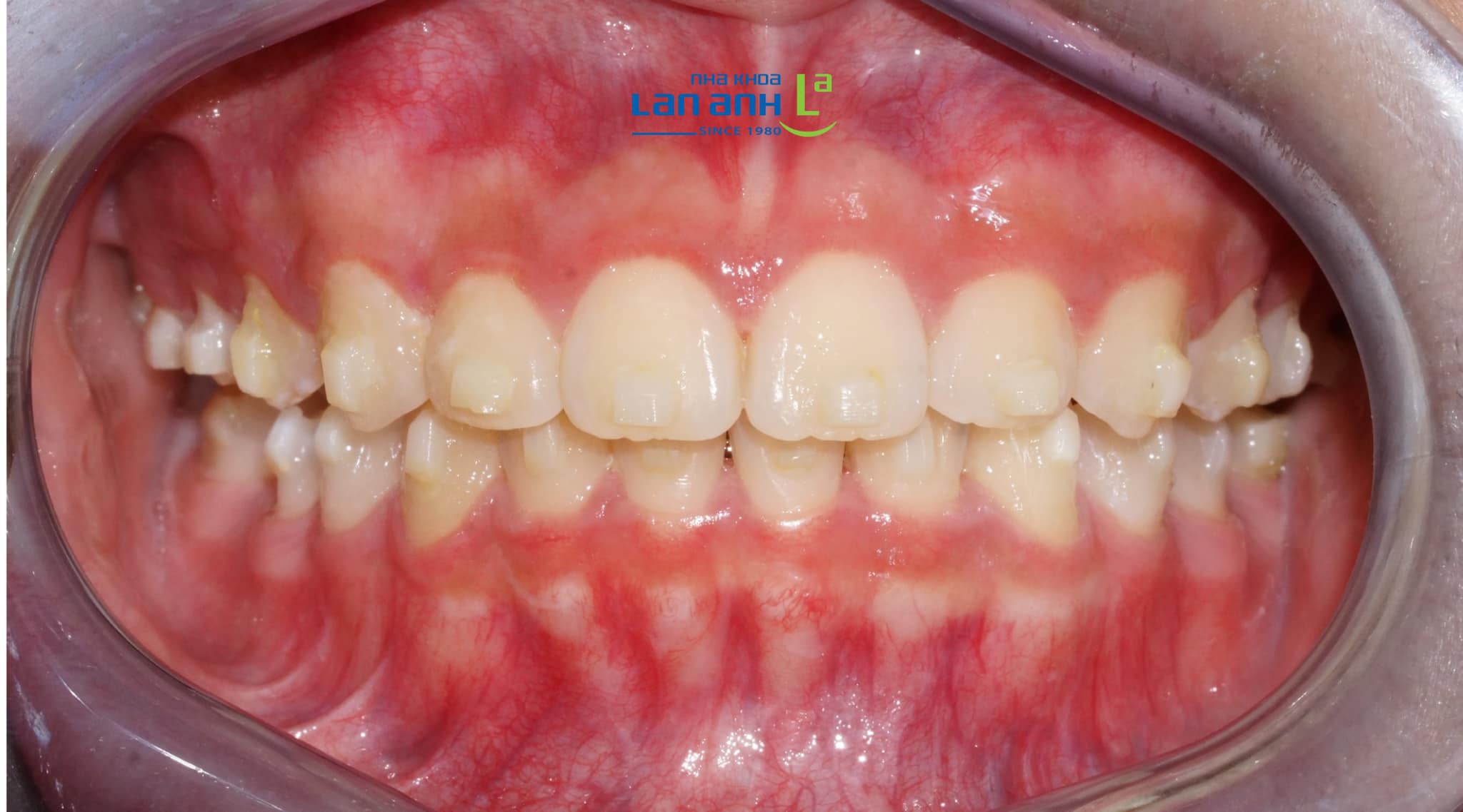 Hình ảnh thực tế niềng răng Invisalign