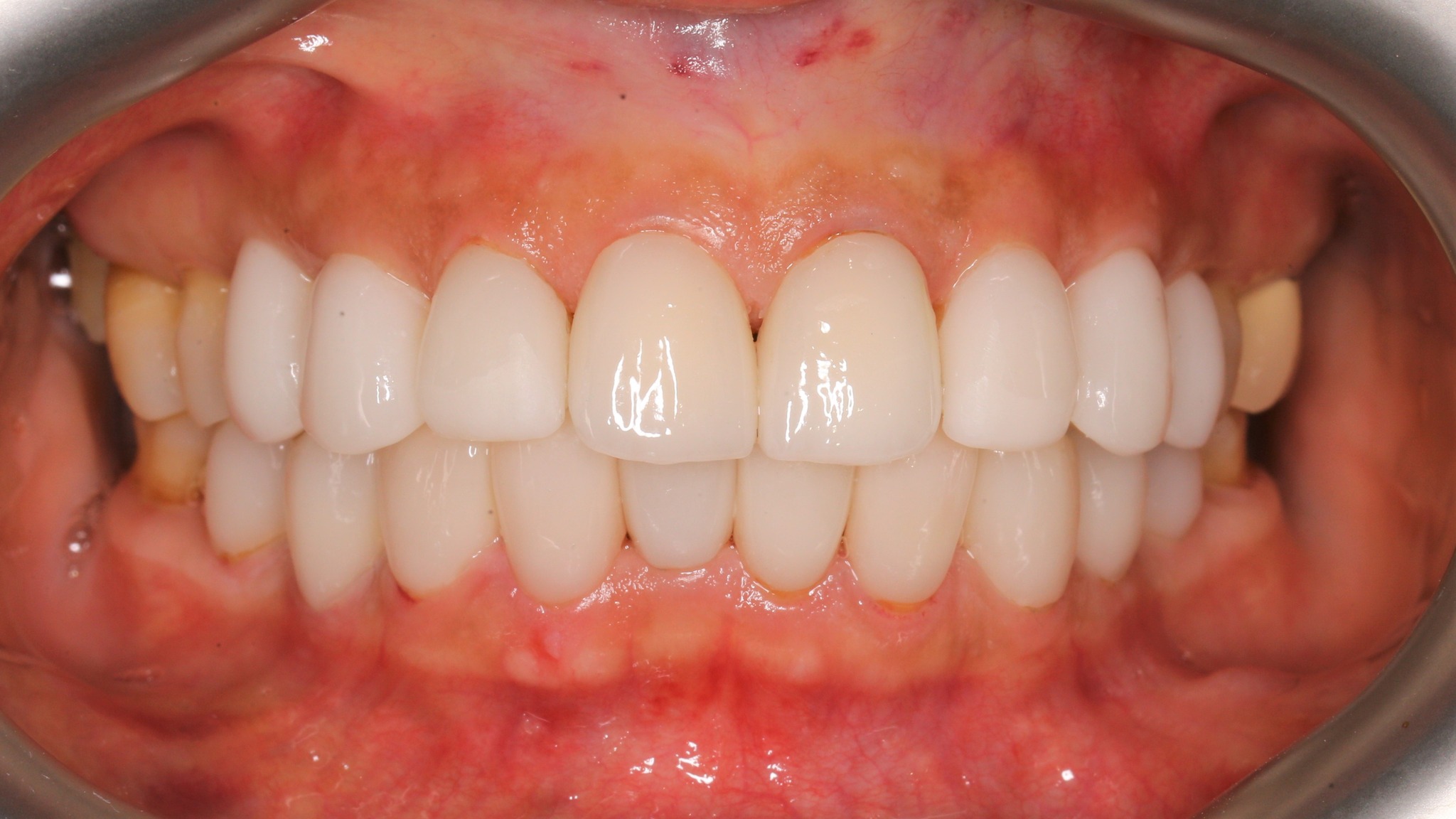 Răng sứ có nhất thiết phải trắng mới đẹp?