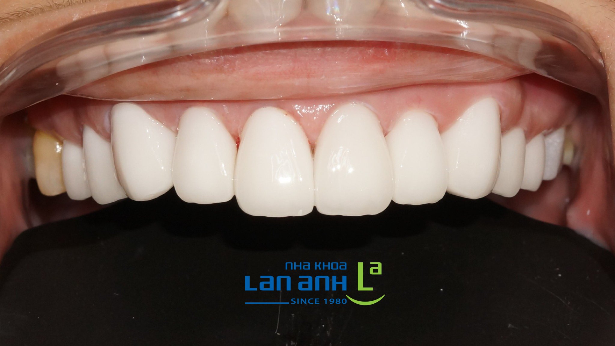 Làm lại Veneer sứ mới