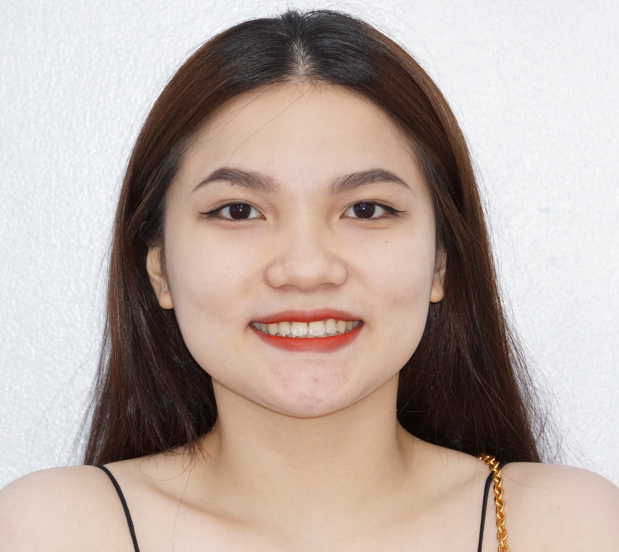 Niềng răng đẹp là như thế nào?