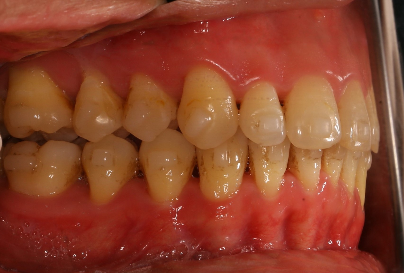 Niềng răng Invisalign điều trị hô