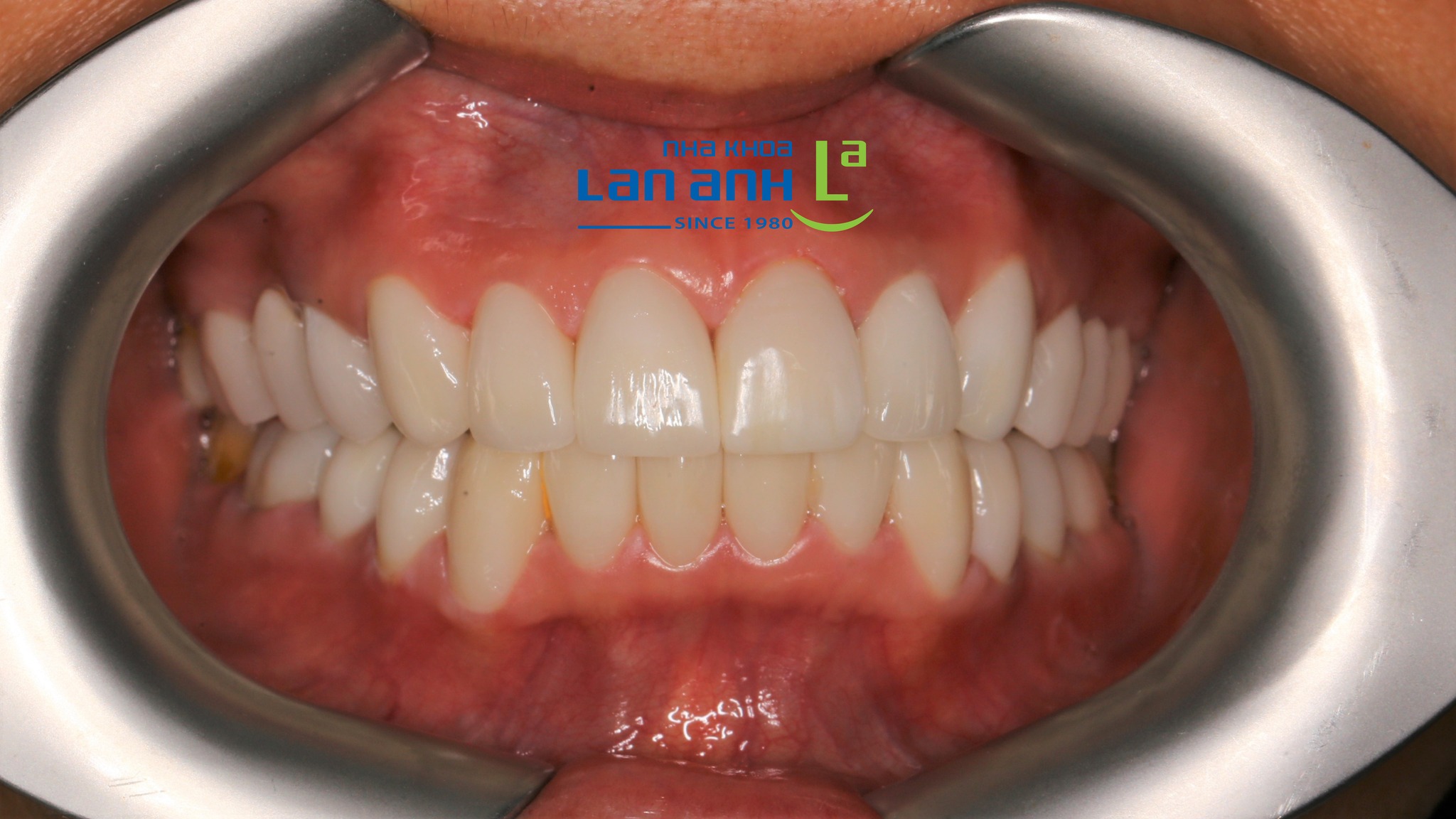 Nụ cười đẹp cần phù hợp với phong cách của riêng bạn