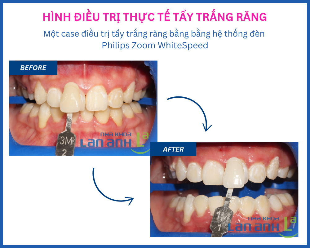 Tẩy trắng răng