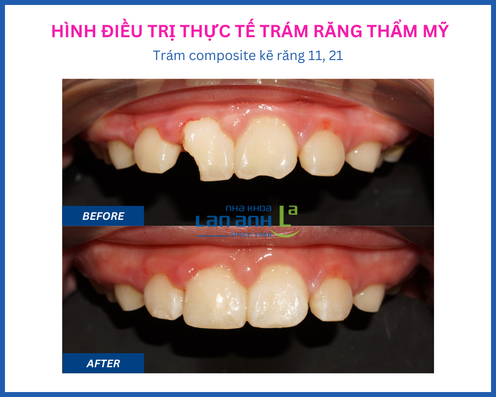 Trám răng thẩm mỹ