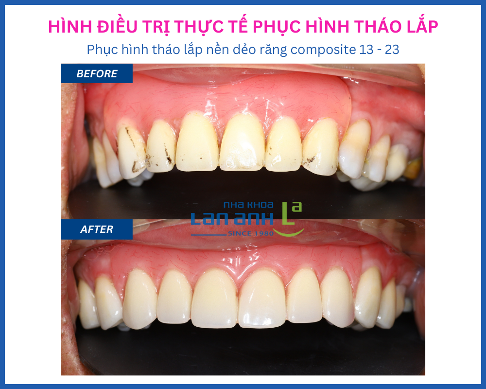 Phục hình tháo lắp