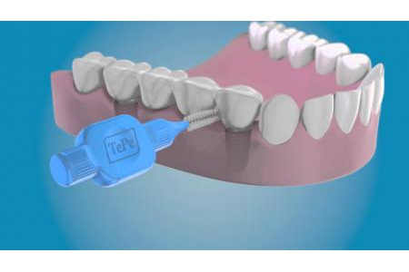 Trồng răng sứ bắc cầu