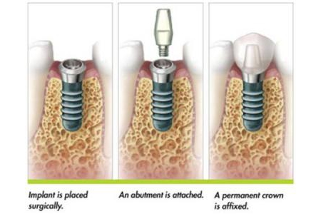 Trồng răng implant tại thành phố Hồ Chí Minh mất bao lâu?