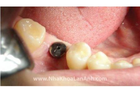 Điều gì giúp trồng răng implant thành công?