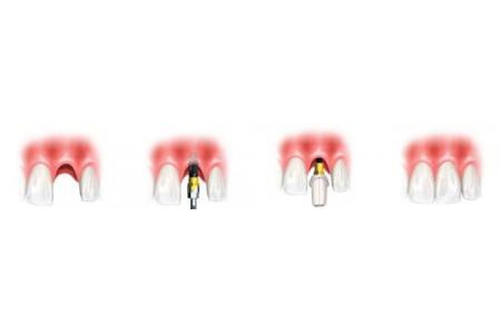 Trồng implant mất bao lâu?