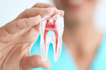 Vì sao bác sĩ khuyên bạn bọc răng sứ sau khi chữa tủy?
